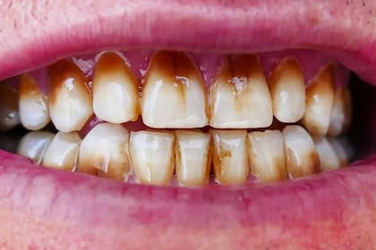 Los pigmentos del café y otras bebidas se alojan contra la encía y a los costados del diente, que es donde se acumula la placa
