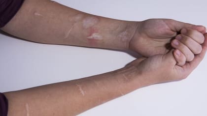 Los problemas mentales pueden llevar a los adolescentes a la autoagresión o al suicidio