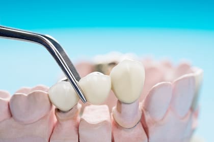 Los puentes dentales son una combinación de coronas unidas entre sí que imitan la forma de un diente perdido