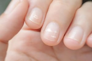 Los significados de las rayas en las uñas que suelen aparecerle a muchas personas