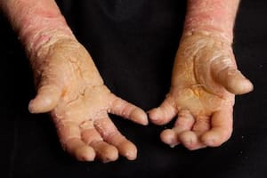La rara enfermedad que hace que la piel crezca demasiado rápido y parezca quemada