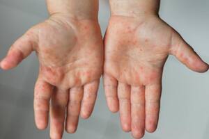 Los síntomas suelen ser la aparición de pústulas, fiebre, dolor corporal, cefalea o dolor de espalda, cansancio generalizado, e inflamación de ganglios, entre otros