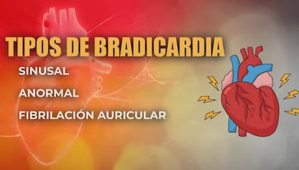 Los tres tipos de bradicardia