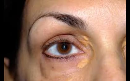 Los xantomas pueden aparecer en párpados, codos, rodillas, manos y pies o glúteos