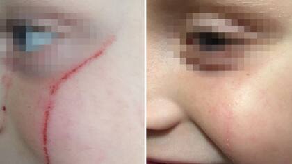 Luego de la raspadura, se utilizó Cicaplast durante 30 días obteniendo este resultado