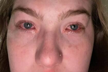 Luego de verse con su novio, la joven experimenta fuertes síntomas de alergía