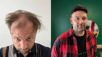 Luke Shepherd dice que decidió hacerse una prótesis capilar porque es más barata que un trasplante