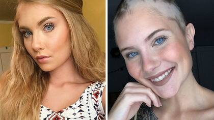 Madisyn padece de alopecia y su mamá usó su cabeza de lienzo para sus fotos de graduación