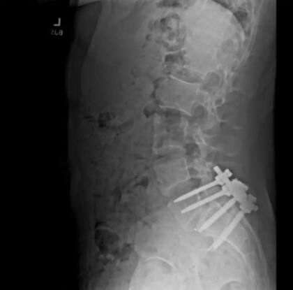 Mangione compartió en X una radiografía de una columna vertebral tras una operación