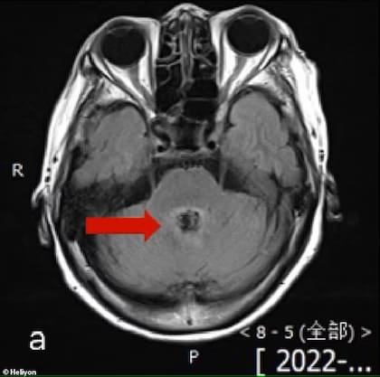 Marca en el cerebro que dejó la ameba