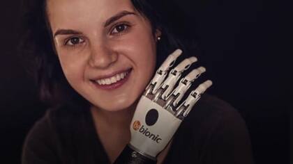 Margarita Gracheva recibió una mano derecha biónica