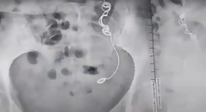 María Aderlinda Forero, de Colombia, tuvo una aguja e hilo alojados dentro de ella durante 11 años