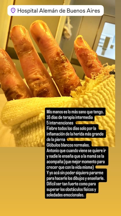 María Julia Olivan mostró cómo tiene su mano tras el accidente doméstico