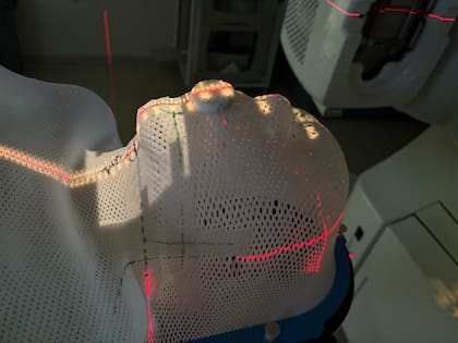 Máscara con el depresor lingual durante una sesión de radioterapia