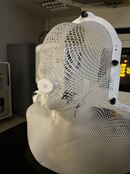 Máscara para radioterapia de cabeza y cuello con el dispositivo argentino para inmovilizar la lengua y la mandíbula