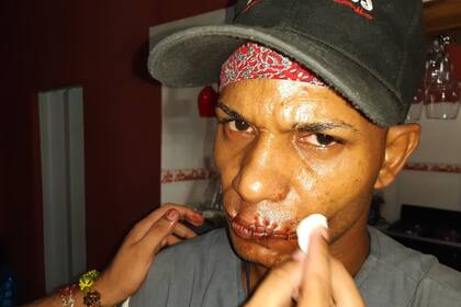 Maykel Osorbo, luego de coserse la boca, a mediados de 2020