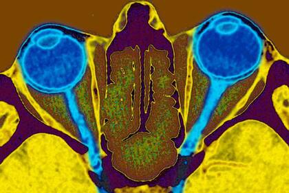 El metanol puede dañar los nervios ópticos, que se muestran aquí en azul conectados a dos ojos en el escáner de un cráneo.