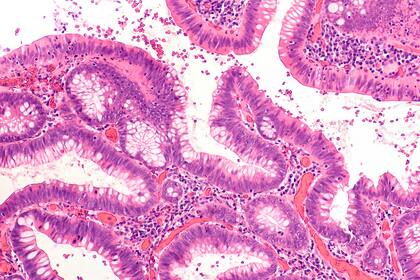 Imagen microscópica de un adenoma velloso