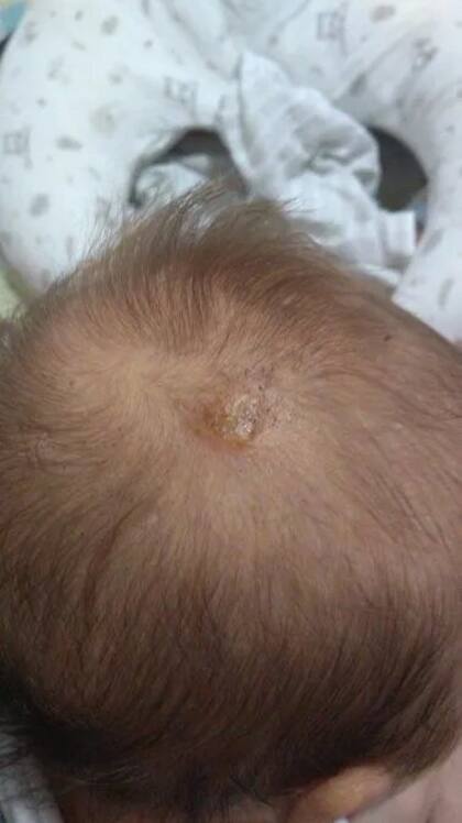 Milo fue tratado en el Hospital del Quemado y está fuera de peligro