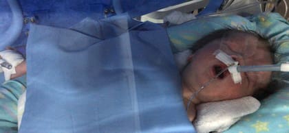 Milo nació con una hipoxia severa. No podía respirar por sus propios medios, estaba azul y sin tono muscular.