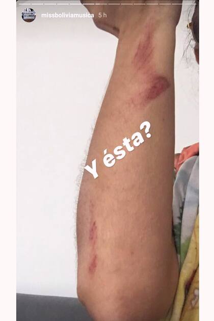La cantante compartió imágenes de raspones en su cuerpo