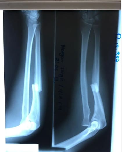 Morgan Segui sufrió múltiples fracturas tras su accidente en Timor Oriental, como esta del brazo derecho, expuesta en una radiografía