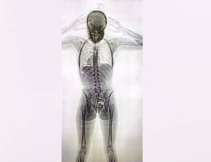 Mula con 78 cápsulas con cocaína en su cuerpo; 11 de ella, por vía intravaginal