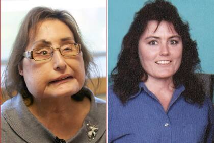 Murió la primera mujer que recibió un trasplante de cara