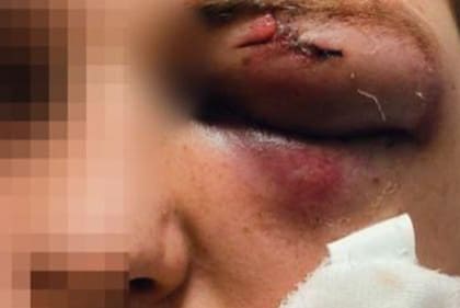 Los médicos no pudieron salvar el ojo de Yaroslav tras el ataque.