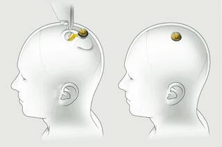 Cómo funciona Telepathy, el chip que permite hablarle a una computadora con el pensamiento