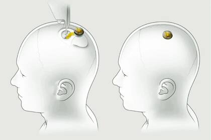 Neuralink, la empresa de Elon Musk, espera luz verde para instalar chips capaces de leer y emitir señales eléctricas para interactuar con el cerebro y el sistema nervioso