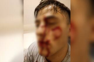 Lo vio con su ex en un boliche y le cortó la cara con una copa de vidrio