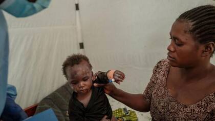 Niño infectado con viruela del mono en la República Democrática del Congo.