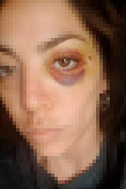 .Noelia tiene 26 años y fue atacada por su novio; tuvo que mudarse a otra provincia para evitar nuevas agresiones