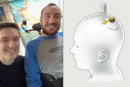Nolan Arbaugh es cuadripléjico y fue la primera persona en tener un chip Neuralink instalado en el cerebro; le permite interactuar con una computadora usando la mente