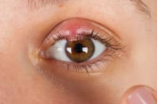 Consejos para prevenir su aparición y cuidar los ojos
