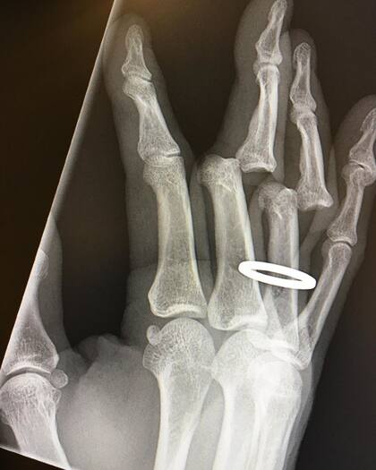 Otra radiografía de cómo le quedó la mano a Tony Hawk. Fuente: Instagram