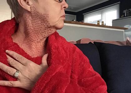 Pagó más de 600 dólares por un tratamiento con plasma de fibroblastos (Crédito: The Sun)