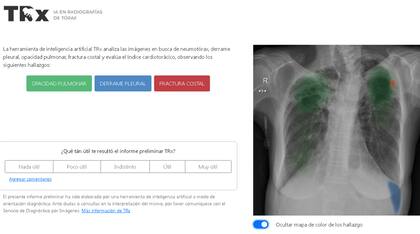 Pantalla con el resultado de la aplicación TRX: hallazgos sugeridos del análisis por IA de una imagen de tórax