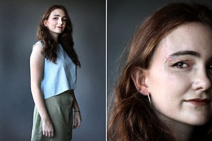 Paula Serrano aprendió a aceptar y a querer la cicatriz que la acompaña desde los 6 años. Foto: Fernando Gutierrez