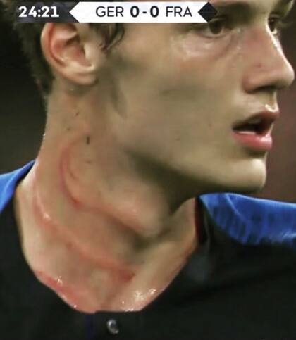 Pavard recibió un pisotón de Rudiger que dejó su huella