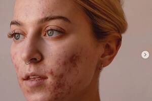 Acné, vitiligo y cicatrices: quiénes son las influencers que muestran su piel al natural