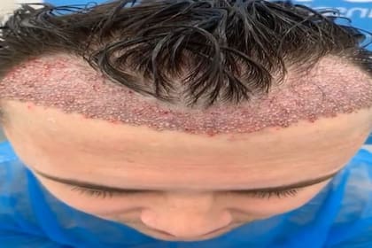 Pocos meses después de la intervención, el pelo no crecía y a cambio la zona de la frente estaba cubierta de horribles cicatrices