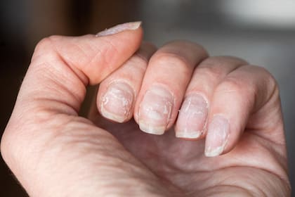 ¿Por qué tus uñas se descaman? Cinco posibles razones