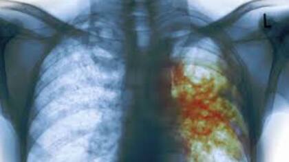 Preocupa el aumento de tuberculosis en todo el mundo, incluida la Argentina