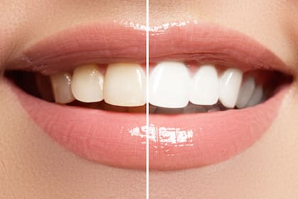 Bicarbonato de sodio, limón o agua oxigenada son algunos de los remedios caseros que los profesionales aseguran  que “no funcionan como blanqueantes dentales”