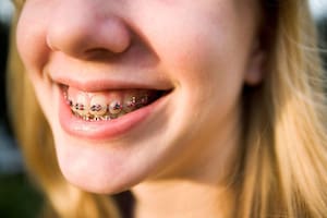 Prohibió dos productos médicos indicados en tratamientos de ortodoncia