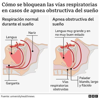 ¿Qué es la apnea de sueño?