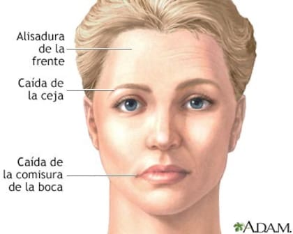 Qué es la caída facial