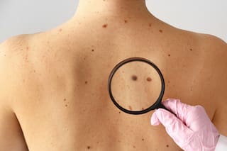 El tratamiento para el cáncer de piel que tiene mayor tasa de curación y pocos lugares realizan